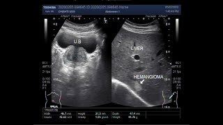 Ultrasound Video showing Hemangioma in Liver [upl. by Brookner]