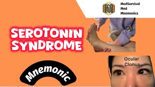 Mnemonic for Serotonin Syndrome signs and symptoms [upl. by Naitirb730]