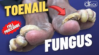 Cutting THICK fungus TOENAILS [upl. by Nnyleuqcaj]