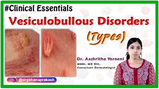 Vesiculobullous disorders Types Clinical essentials DrAashritha yerneni [upl. by Irpak970]