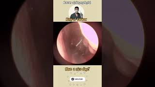 귀지형 콧물 부비동염 축농증 비염 코청소 이비인후과 rhinorrhea rhinitis sinusitis asmr ENT entdoctor [upl. by Fitzger]