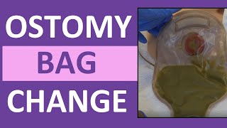 Ostomy Bag Pouch Change  Ostomy Care Nursing  Colostomy Ileostomy Bag Change [upl. by Ninehc]