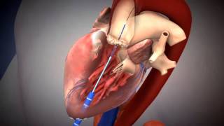 SAPIEN TAVR Deployment Using Transapical Approach [upl. by Curson]