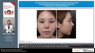 Use of Autologous AdiposeDerived Stromal Vascular Fractions in Revision Rhinoplasty for Severe [upl. by Redwine535]