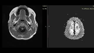 case 11a  7 year old male patient [upl. by Akihsat]