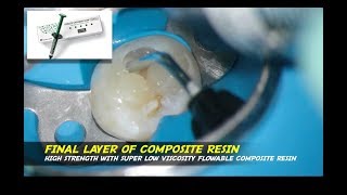 class I cavity with estelite universal flow super low palfique bulkflow endodontist jakarta [upl. by Oicnoel50]