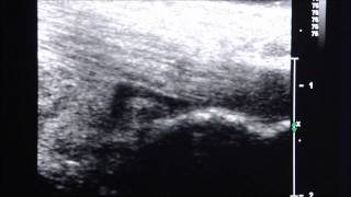 UltrasoundGuided Injection of Retrocalcaneal Bursitis [upl. by Druci]