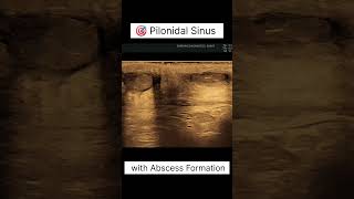 🎯 Pilonidal Sinus with Abscess Formation on Ultrasound 💉 eurevaadiagnostics ultrasound pilonidal [upl. by Brit89]