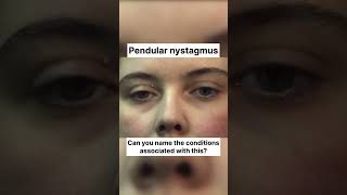 Pendular Nystagmus eyes ophthalmology optometry [upl. by Valentine]