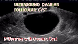 TVS Ultrasound Ovarian Follicular Cyst  Difference with Ovarian Cyst  is This Serious [upl. by Asserat240]