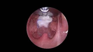 Intraoperative Endoscopy View of The Throat after Coblation Tonsillectomy [upl. by Miran]