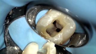 GuttaCore®  Dr Manor Haas  Placement and Sealer Dentsply Sirona [upl. by Thorley387]