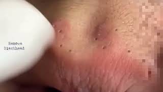 Acne on Forehead  Blackhead Removal on his forehead  Acne Treatment removeblackhead [upl. by Rosalia]