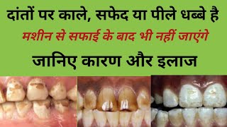 दांतों पर से काले सफेद या पीले धब्बे कैसे साफ करेंteeth fluorosis treatment teeth cleaning [upl. by Rego]