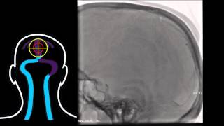 Interventional Stroke Rounds  Venous Sinus Thrombosis [upl. by Ahern]