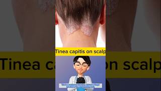 Whats wrong with scalp fungal infection  Doctor explains tinea capitis idoctor [upl. by Ihc907]