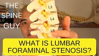 What is Lumbar Foraminal Stenosis [upl. by Annelak]