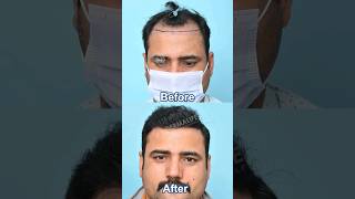 Repair Hair Transplant Before After Result  Corrective Hair Transplant in India [upl. by Masry]