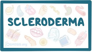 Scleroderma  an Osmosis Preview [upl. by Yeuh]