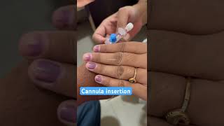 Cannula insertion of male patient on Thumb nurses cannula doctor neet mbbs bscnursing shorts [upl. by Freytag601]