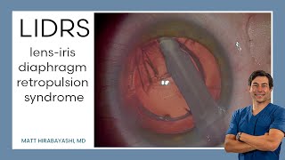 LIDRS lensiris diaphragm retropulsion syndrome Explanation and Demonstration [upl. by Lorrin]