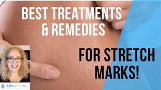 BEST TREATMENTS amp REMEDIES FOR STRETCH MARKS [upl. by Nalda]