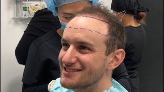 How to decide your Hair Transplant hairline height PT2￼ [upl. by Callas583]