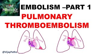 EMBOLISM Part 1 Pulmonary amp Systemic thromboembolism [upl. by Ahsiened491]