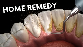 Teeth plaque tartar removal  Health Go [upl. by Gamal]