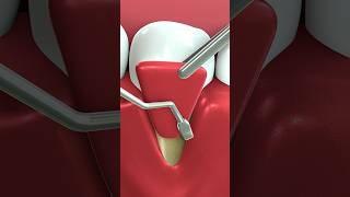 What is gum graft treatment  Dental repair Surgery 3D Animation [upl. by Sharity]