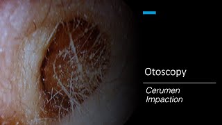 Cerumen Impaction Otoscopy [upl. by Tannenbaum8]