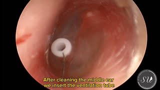 Myringotomy and Ear tube insertion by Dr Uluyol Orta kulağa ventilasyon tüpü takılması [upl. by Norted527]