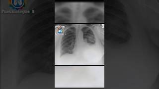 Radiographie thoracique chest xray radiologiest radiographie [upl. by Lothario611]