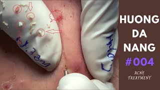 004  Nhat part 2  Super squeeze acne asmr  Yêu nặn mụn  trattamento acne [upl. by Larissa840]