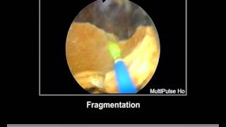 Bladder Stone Holmium Laser [upl. by Hake]