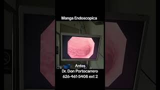 Manga Endoscopica Antes con el Dr Don Portocarrero [upl. by Tuttle]