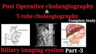 Ttube cholangiography  Post operative cholangiography  Biliary imaging system part 3 [upl. by Rame]