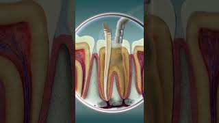 Root Canal Treatment  Curveia Dental I RCT [upl. by Thurber]