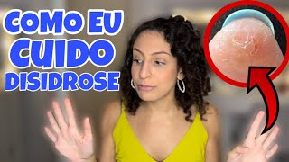 EU TENHO DISIDROSE  minha história [upl. by Aleinad]