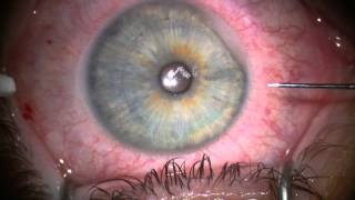 Stephen Slade MD Image Guided LASIK Flaps [upl. by Arahsat843]