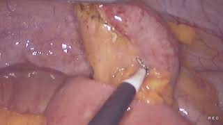 Laparoscopic appendectomy unedited 882024 [upl. by Cobbie]