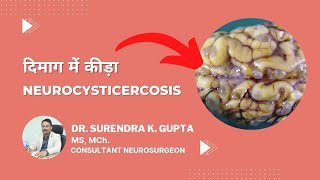 What is neurocysticercosis  Tapeworm  How it spreads  Treatments [upl. by Eberhard]