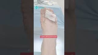 Chirurgie du pied جراحة القدم لتقويم اعوجاج الابهامrabat meknes marrakech tanger [upl. by Dnalram]