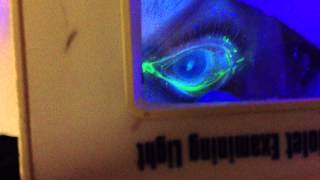 Fluorescein Staining of an Eye [upl. by Tecil]