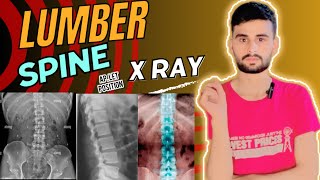 Lumber spine  lumber spine x ray  lumber spine c ray positioning  x ray [upl. by Blainey]