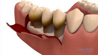 Parodontie par lambeaux  Centres dentaires Lapointe [upl. by Ibloc]
