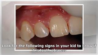 Abscessed Tooth In Child  Causes Symptoms And Treatment [upl. by Sherry]