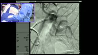 Transradial Embolization of a Splenic Artery Aneurysm  Part 2 Embolization  6 min cut [upl. by Thistle506]