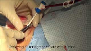 Thrombectomy of dialysis AVG [upl. by Adne]