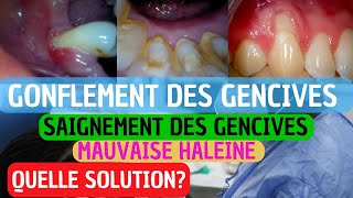 Pourquoi Vos Gencives Saignent  Causes Prévention et Traitement de la Gingivite [upl. by Eatnuahc]